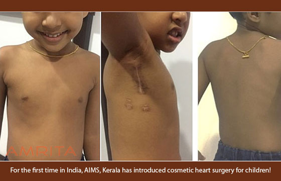 Cosmetic Cardiac Surgery for Children in AIMS, Kerala